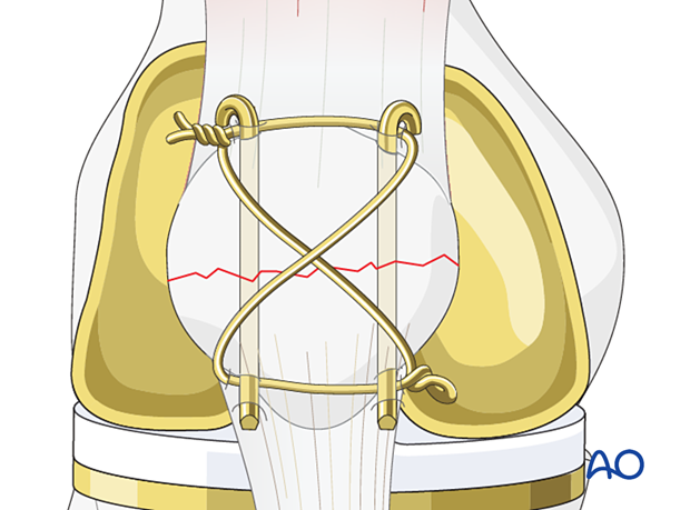 Bend the proximal pin ends, shorten them, turn them towards the quadriceps tendon