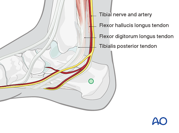 Calcaneal pin insertion