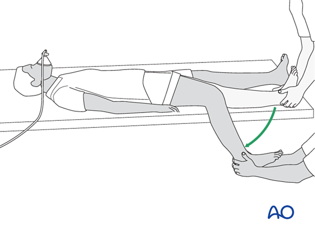 Fracture reduction