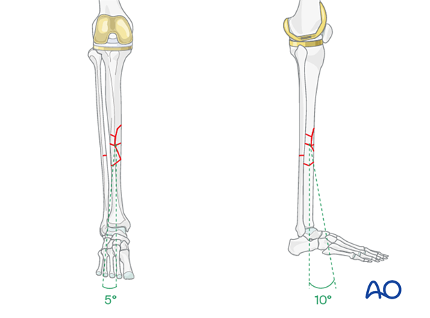 Aligning the anterior tibial crest of the distal fragment with the proximal one