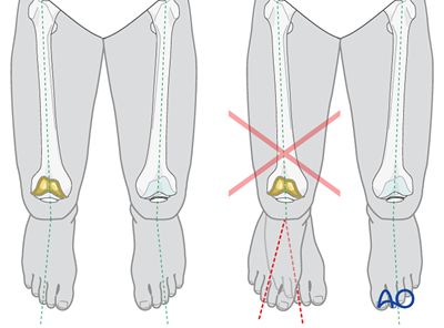 Splint or plaster for Fracture distal to the tibial component and ...