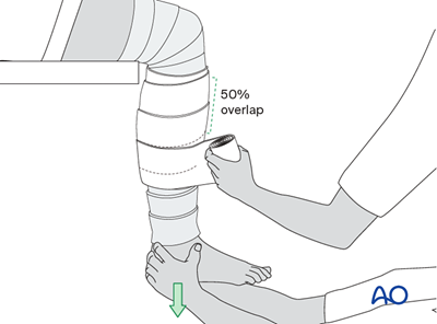 Splint Or Plaster For Fracture Distal To The Tibial Component And 