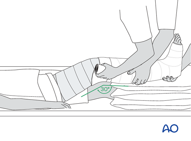 One caregiver holds the foot and lower leg to maintain flexion of the knee at about 30° and the other extends the padding and the plaster as high as the upper thigh