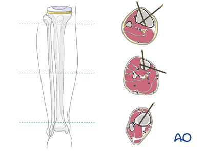 Temporary external fixator for Fracture distal to the tibial component ...