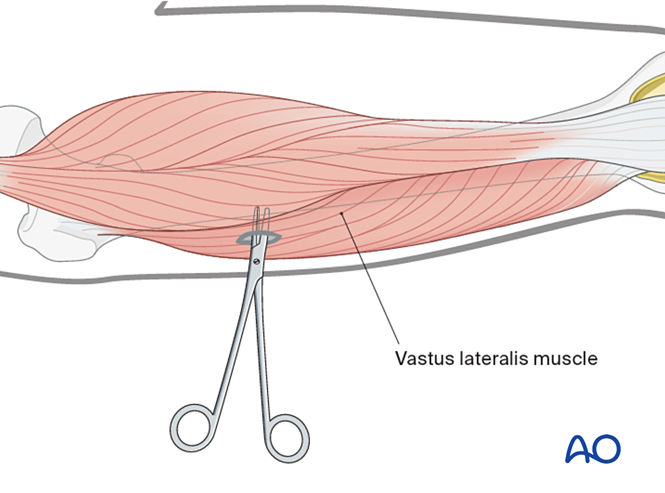 Temporary external fixator for Nondisplaced tibial plateau or tubercle ...