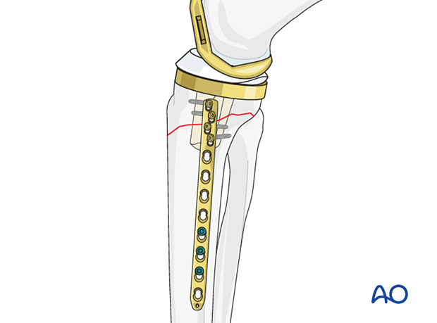 Fracture fixation