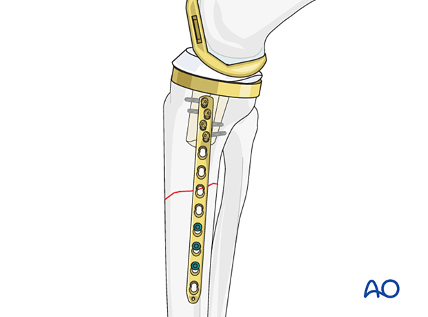 Fracture fixation
