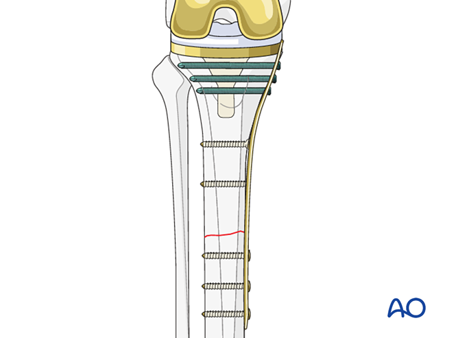 Compression plate for Fracture distal to the tibial component and ...
