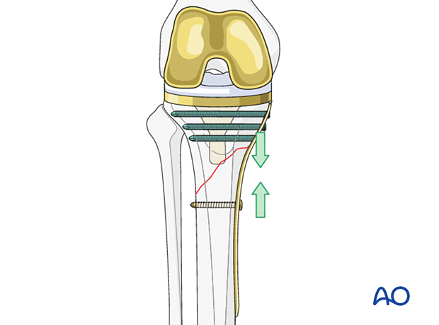 Plate fixation for short oblique fractures