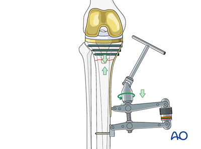 Compression plate for Fracture around a stable tibial component with ...