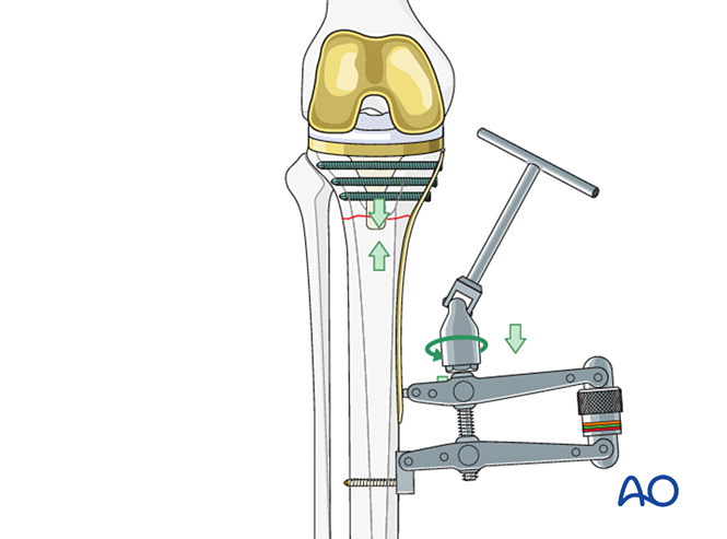 Compression plate for Fracture around a stable tibial component with ...
