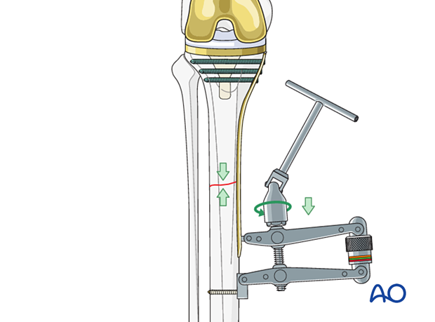 An articulated tensioning device can be used for reduction