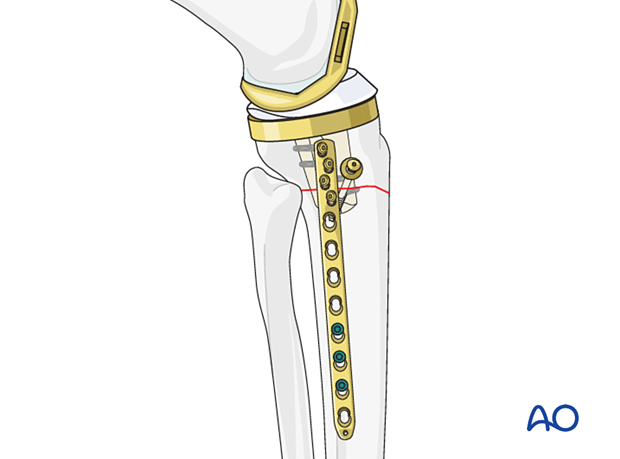 P330 B1C Tibia lag screw with or without neutralization plate