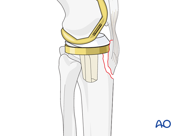 Stabilization of periprosthetic fractures that disrupt the extensor mechanism at the tibial tubercle