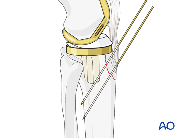 Provisional fixation is attained with K-wires