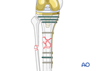 distant to the tibial component and cement mantle
