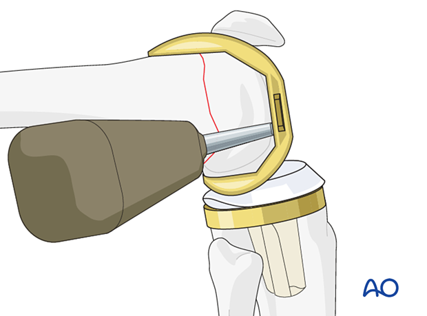 Removal of the femoral component