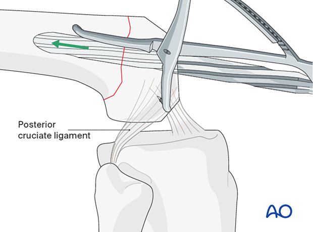 Femoral preparation