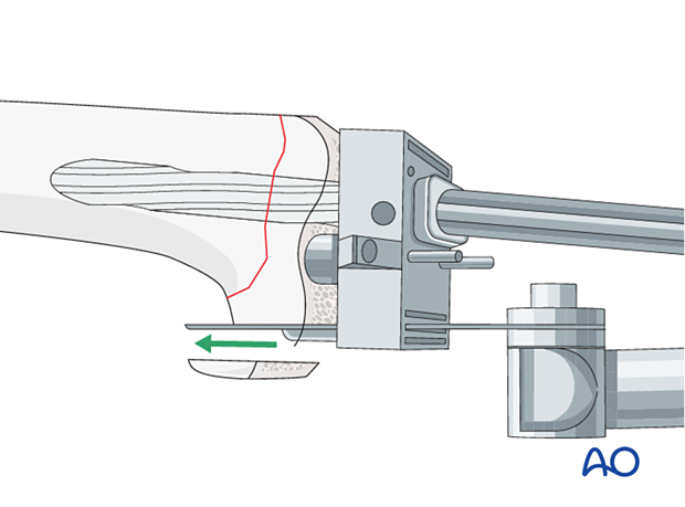 An intramedullary femoral cutting jig is used to make the appropriate bone cuts