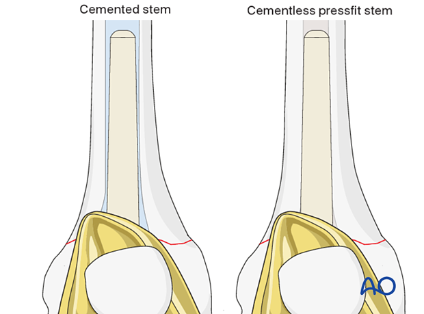 The diameter of the stem is determined by the reamer diameter which achieves cortical contact with the diaphyseal bone