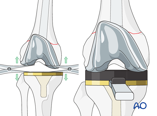 Gap balancing and knee stability assessment