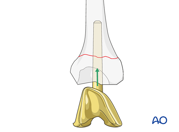 Insertion of the femoral component