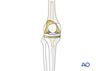 Complete revision: varus/valgus (CCK) constrained knee