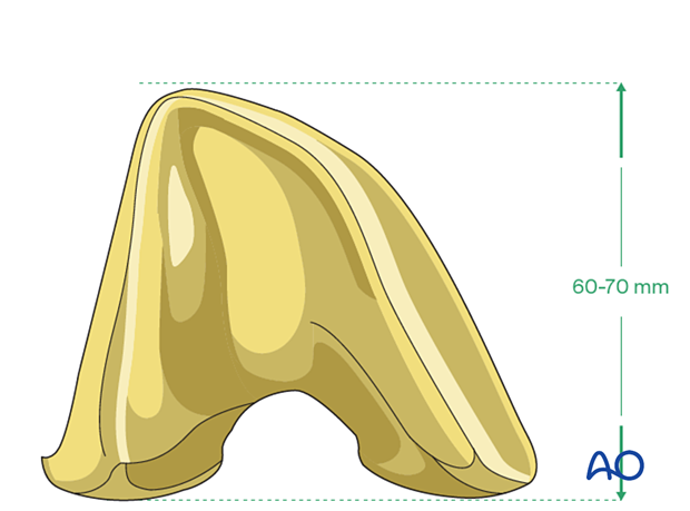 Length of hinged femoral component