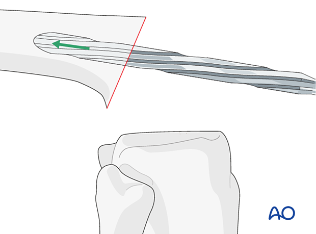 The femoral canal is prepared with reamers of increasing size