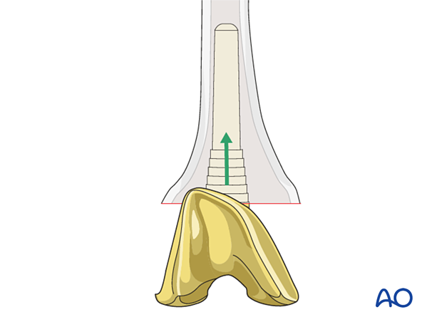 The monobloc implant is inserted into the femur
