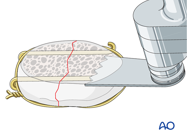 P420 Patella component revision with or without ORIF