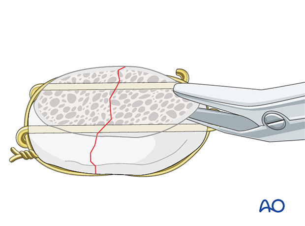 P420 Patella component revision with or without ORIF