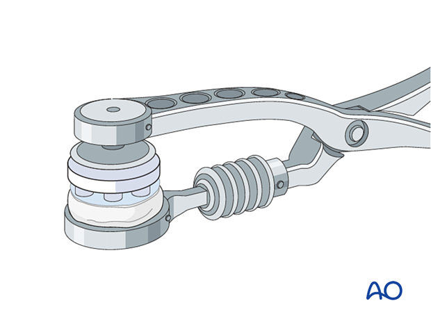 P420 Patella component revision with or without ORIF