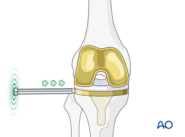 P420 Patella component revision with or without ORIF