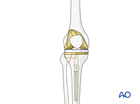 Complete revision of tibial components with CCK