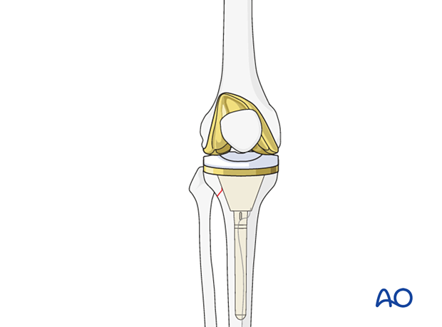 P425 Complete revision of tibial components with CCK