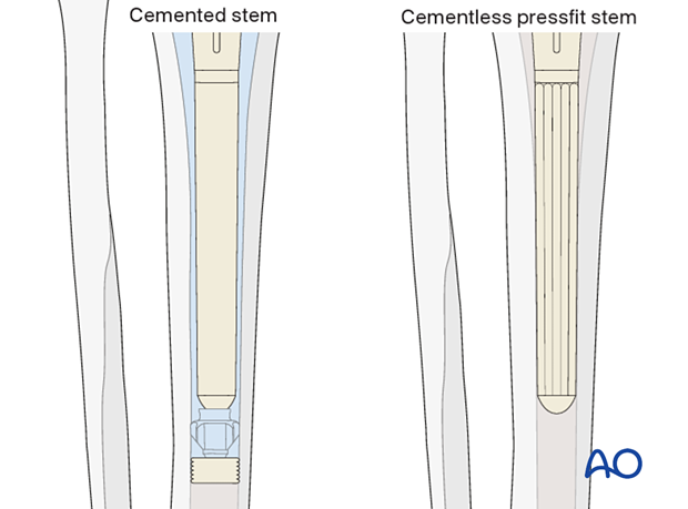 P425 Complete revision of tibial components with CCK