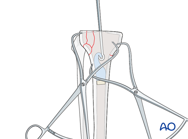 Cement removal in the tibial metaphysis