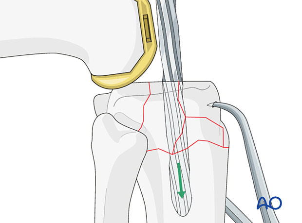 Preparation of the tibial canal