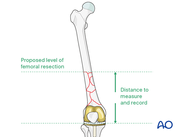 Length of hinged femoral component