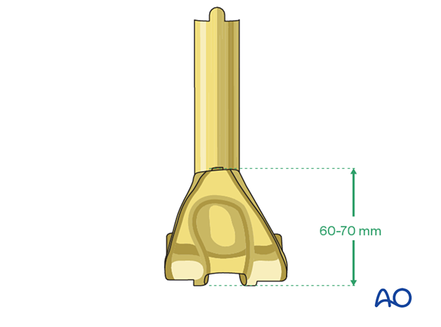 The minimum length of the distal femoral replacement prosthesis is 60-70 mm