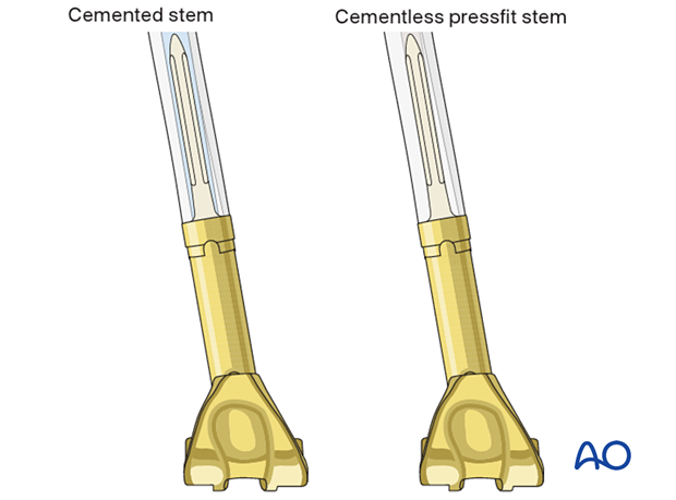 The diameter of the stem is determined by the reamer diameter which achieves cortical contact with the diaphyseal bone.