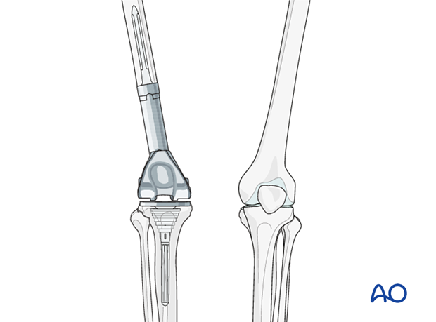 P445 Distal femoral replacement