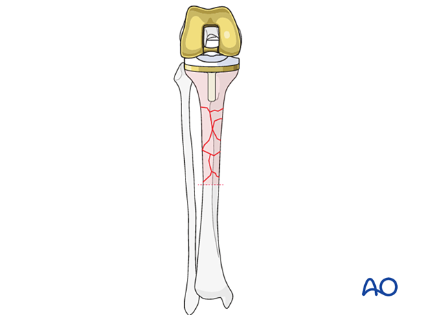 Tibial component removal