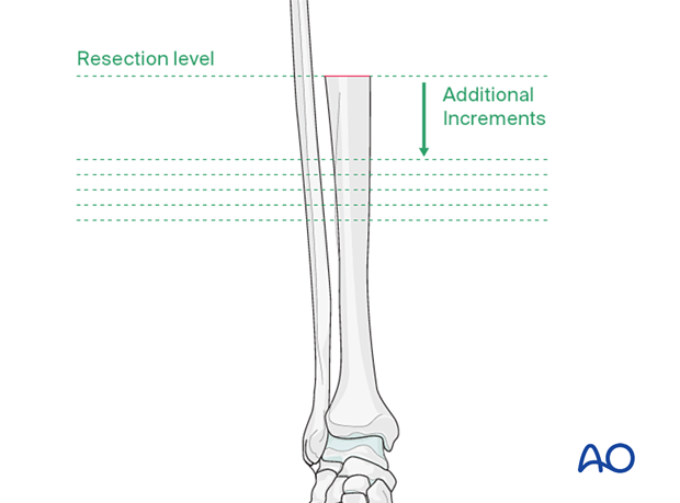 Preparation of the tibia