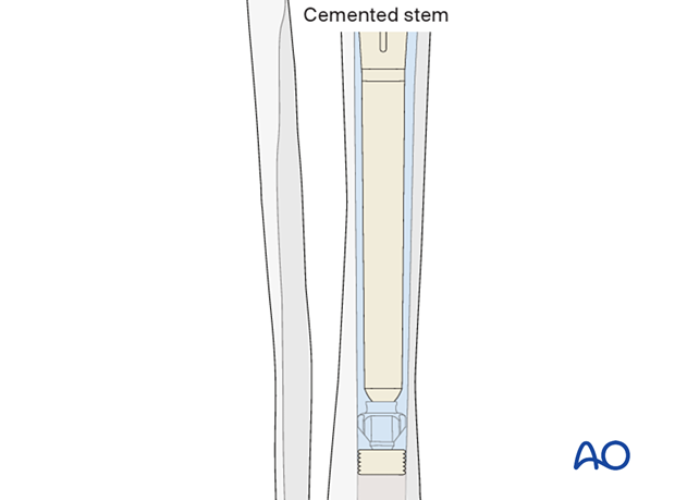 One should allow for at least 2 mm of cement mantle around the stem