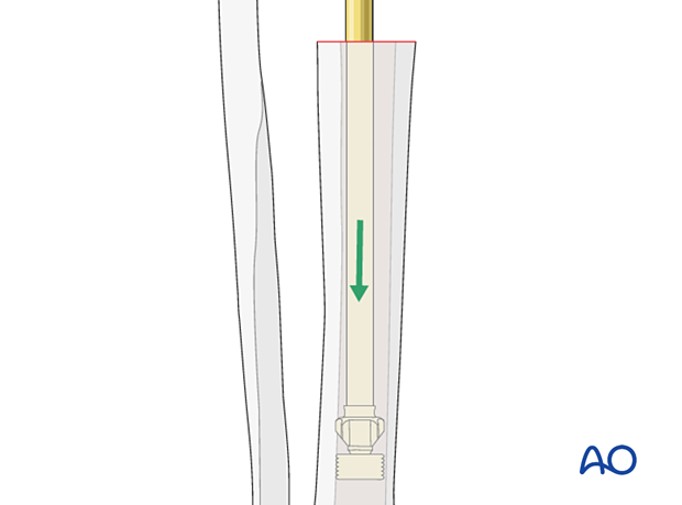 Cement restrictor