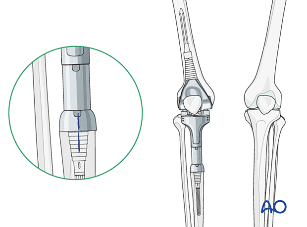 Tibial component