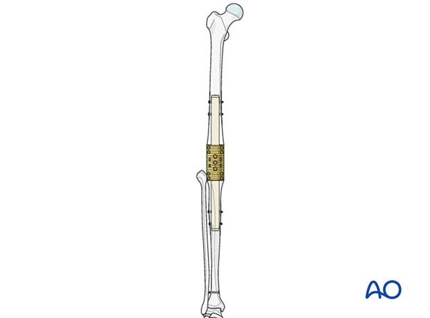 modular metallic intramedullary device for bone loss