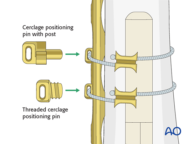 Cerclage positioning pins